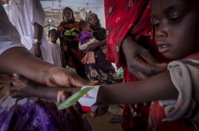 طفل سوداني يعاني من سوء التغذية